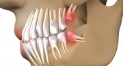 Żegnajcie implanty, w miejscu wyrwanego zęba wyrośnie nowy i to w 9 tygodni!