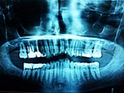 Rosja: Dentystka usunęła pacjentce zdrowe 22 zęby